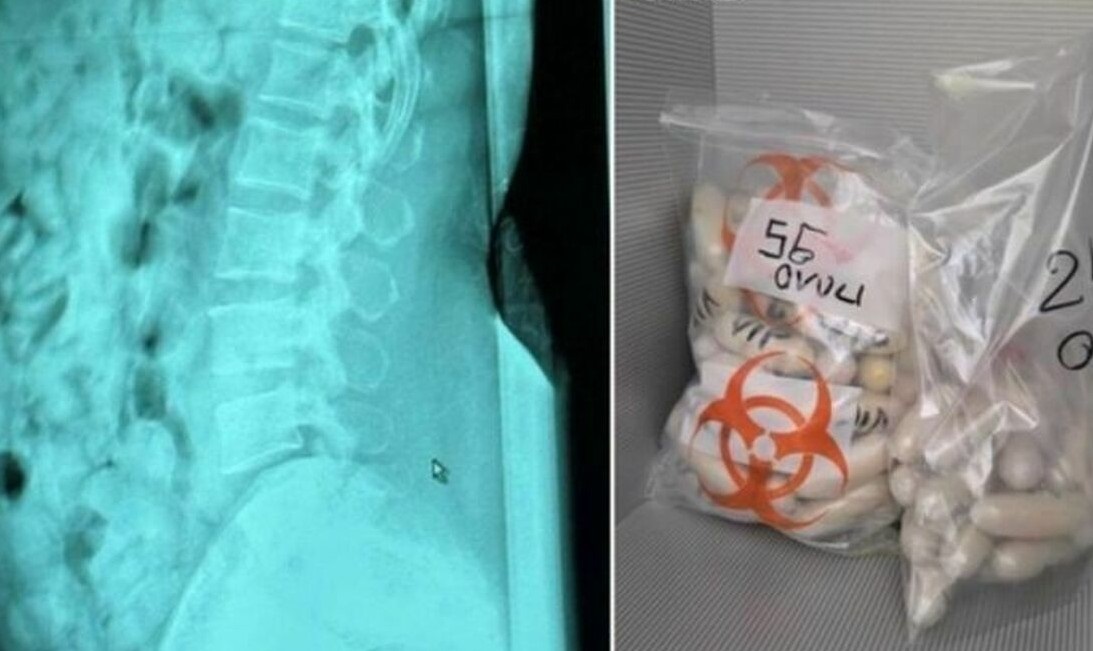Новини світу - В Італії затримано жінку з 1,4 кг героїну в шлунку